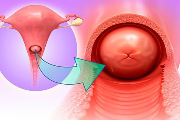 Các vấn đề cổ tử cung thường gặp: từ viêm, polyp đến sàng lọc