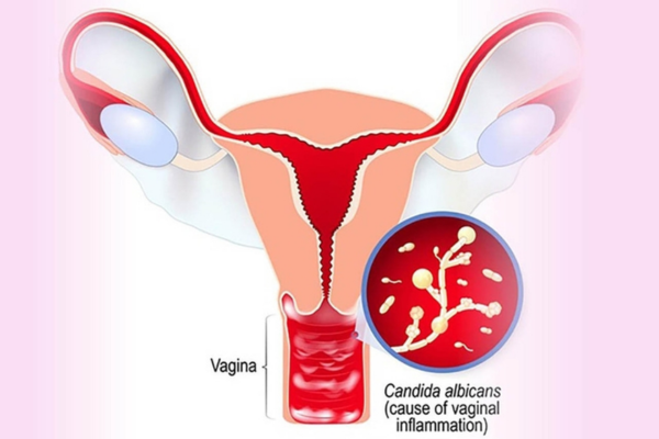 Nấm âm đạo: nhận biết triệu chứng và xác nhận trước khi tự chữa
