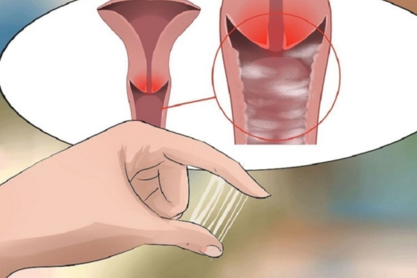 Dịch âm đạo bất thường: checklist thay đổi nào đáng chú ý hơn màu đơn lẻ
