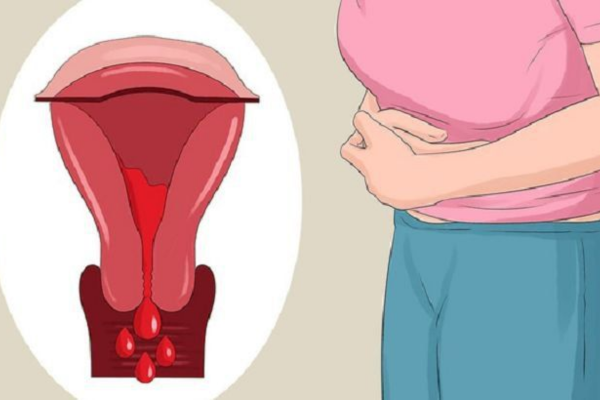 Chảy máu âm đạo bất thường: đánh giá lượng máu và nguy cơ mất máu