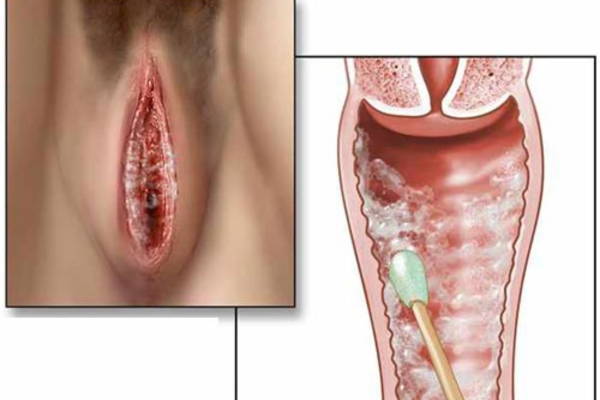 Nấm Candida: phân biệt hiện diện tự nhiên và các dạng nhiễm trùng