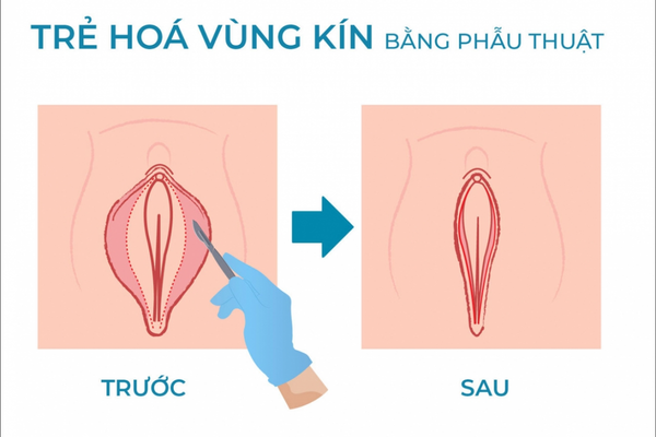 Cắt môi bé vùng kín: điều cần cân nhắc trước can thiệp