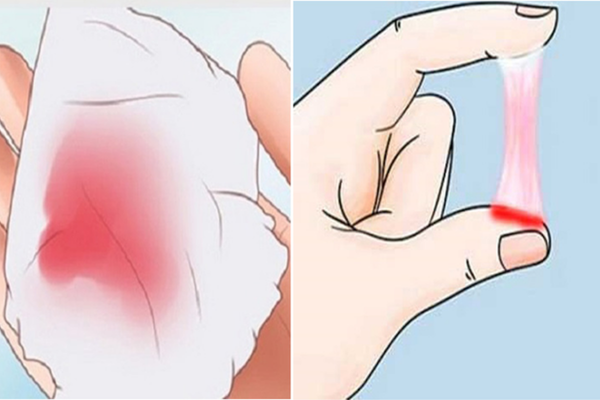 Rong kinh: theo dõi lượng máu và lựa chọn điều trị phù hợp