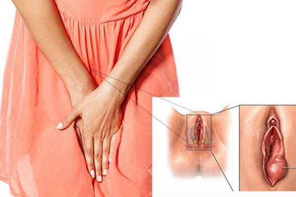 Sưng âm đạo: nguyên nhân, dấu hiệu cần khám và cách xử trí