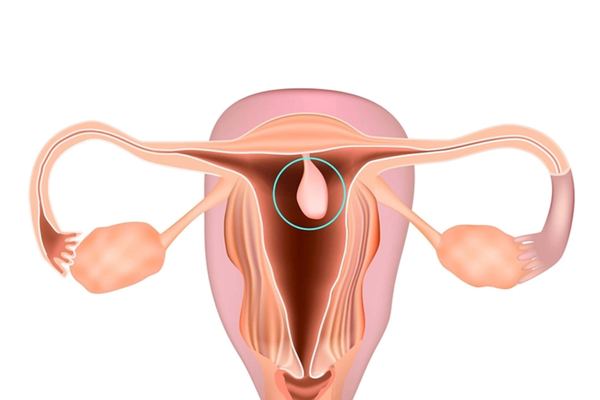 Polyp cổ tử cung: nhận biết và phân biệt với polyp buồng tử cung