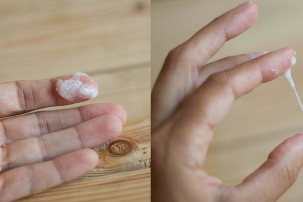 Khí hư vón cục: nguyên nhân và cách kiểm tra khi tái diễn