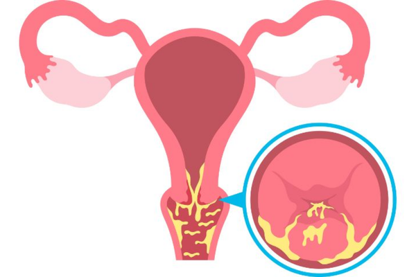 Lộ tuyến cổ tử cung độ 2: đánh giá triệu chứng và lựa chọn chăm sóc