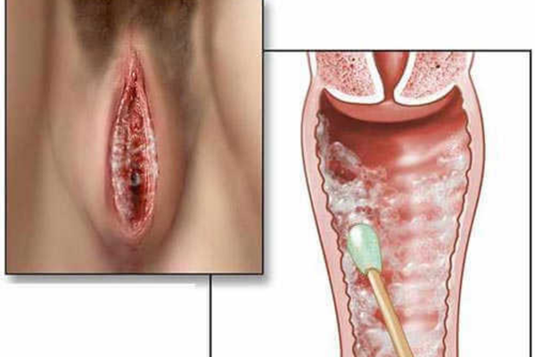 Nấm âm đạo: triệu chứng, nguyên nhân tái phát và điều trị