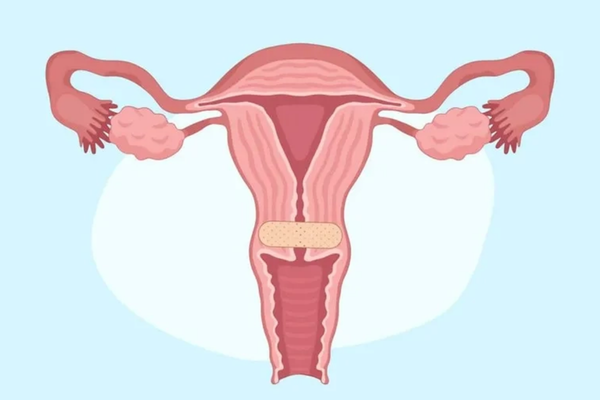 Viêm cổ tử cung là gì? Phân biệt với lộ tuyến và tổn thương tế bào